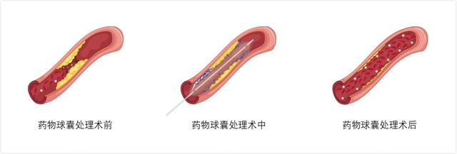 微球栓塞.png